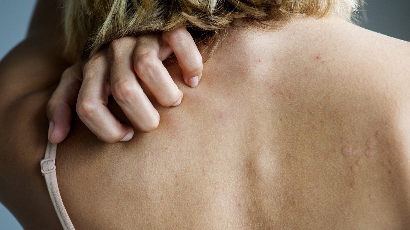 Woman with hives scratching her itchy back