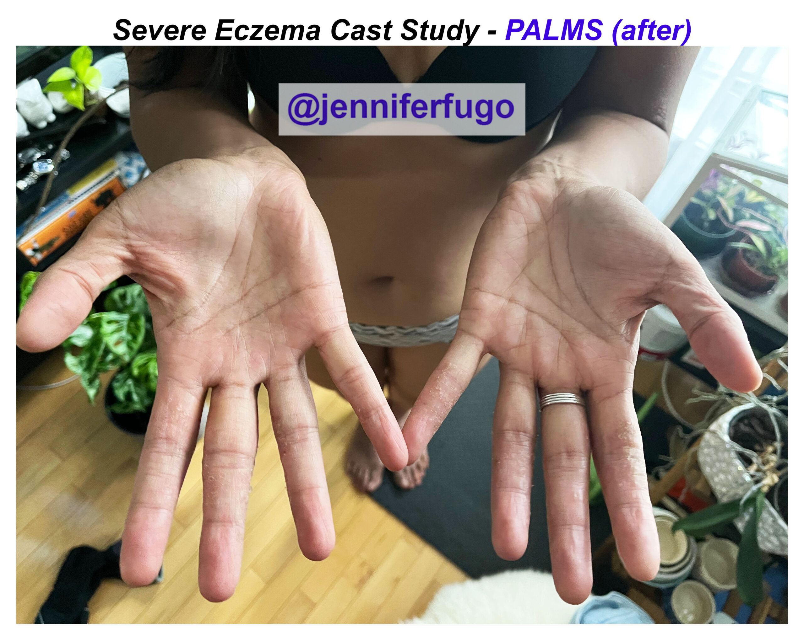 Eczema on feet palms AFTER