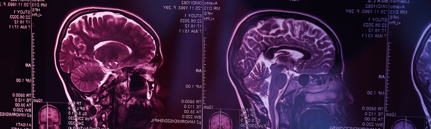 brain MRI scans