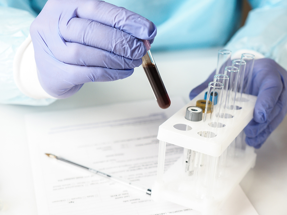 uric acid blood test