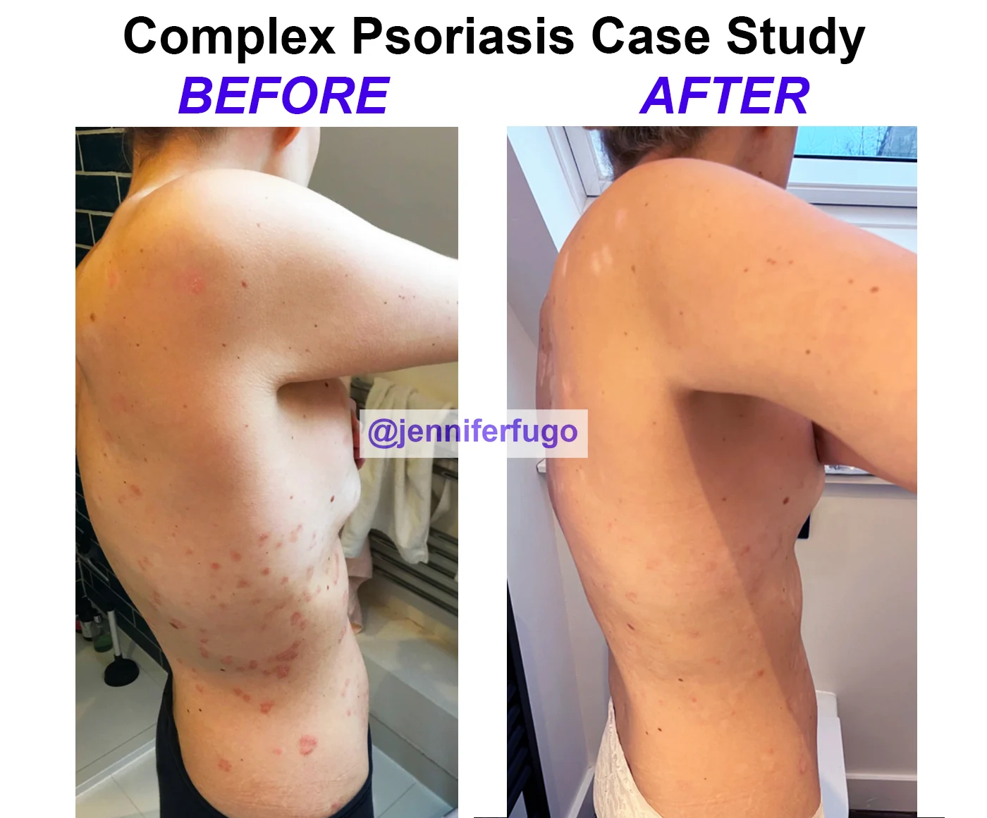 complex psoriasis case study before and after