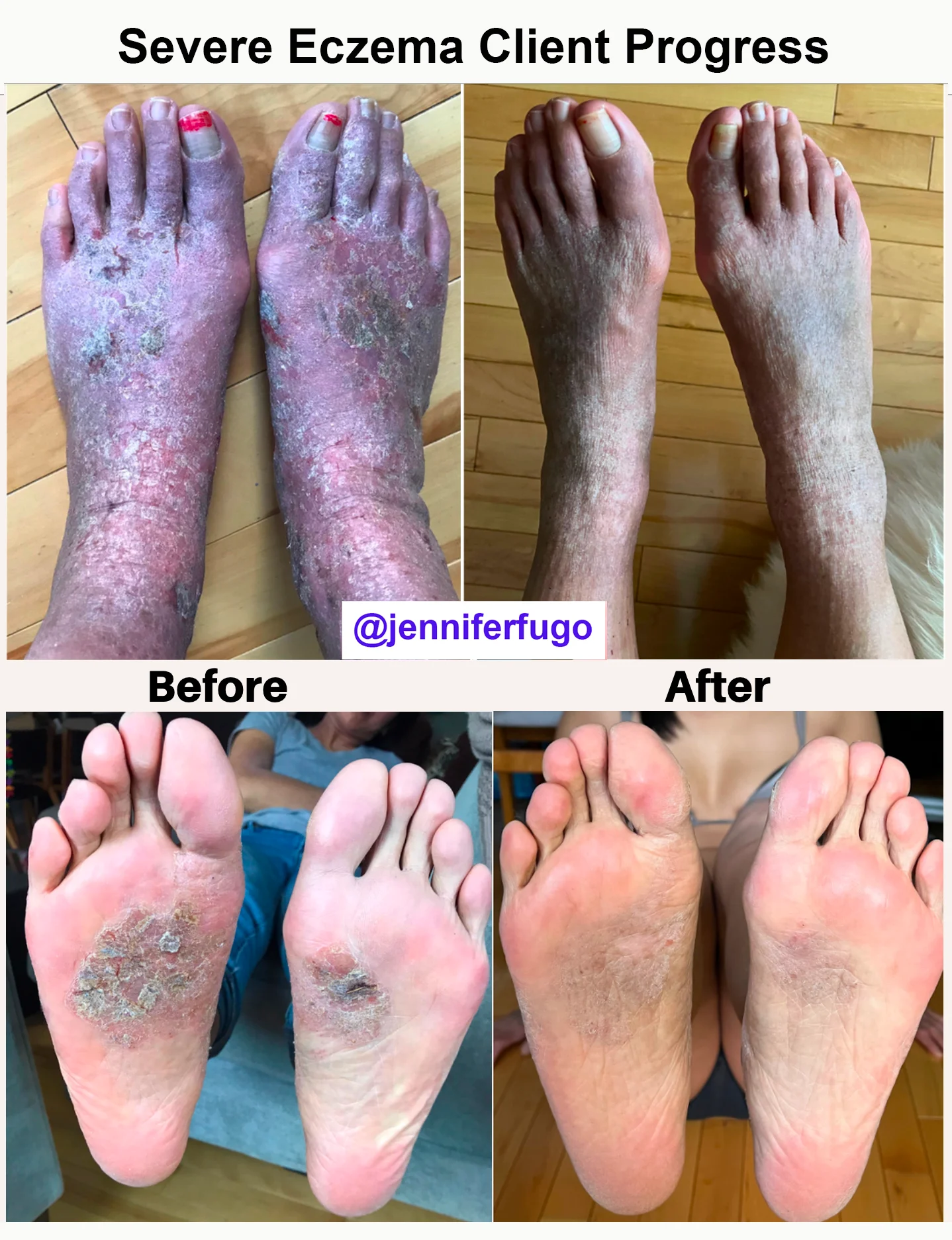 severe eczema on feet before and after photos