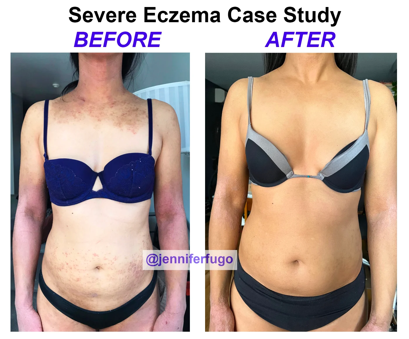 eczema on torso before and after photos