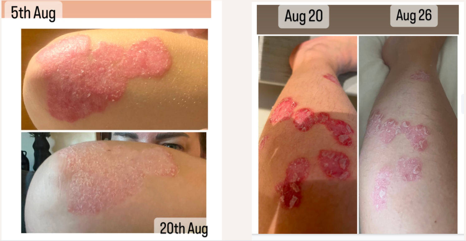 psoriasis before and after photos