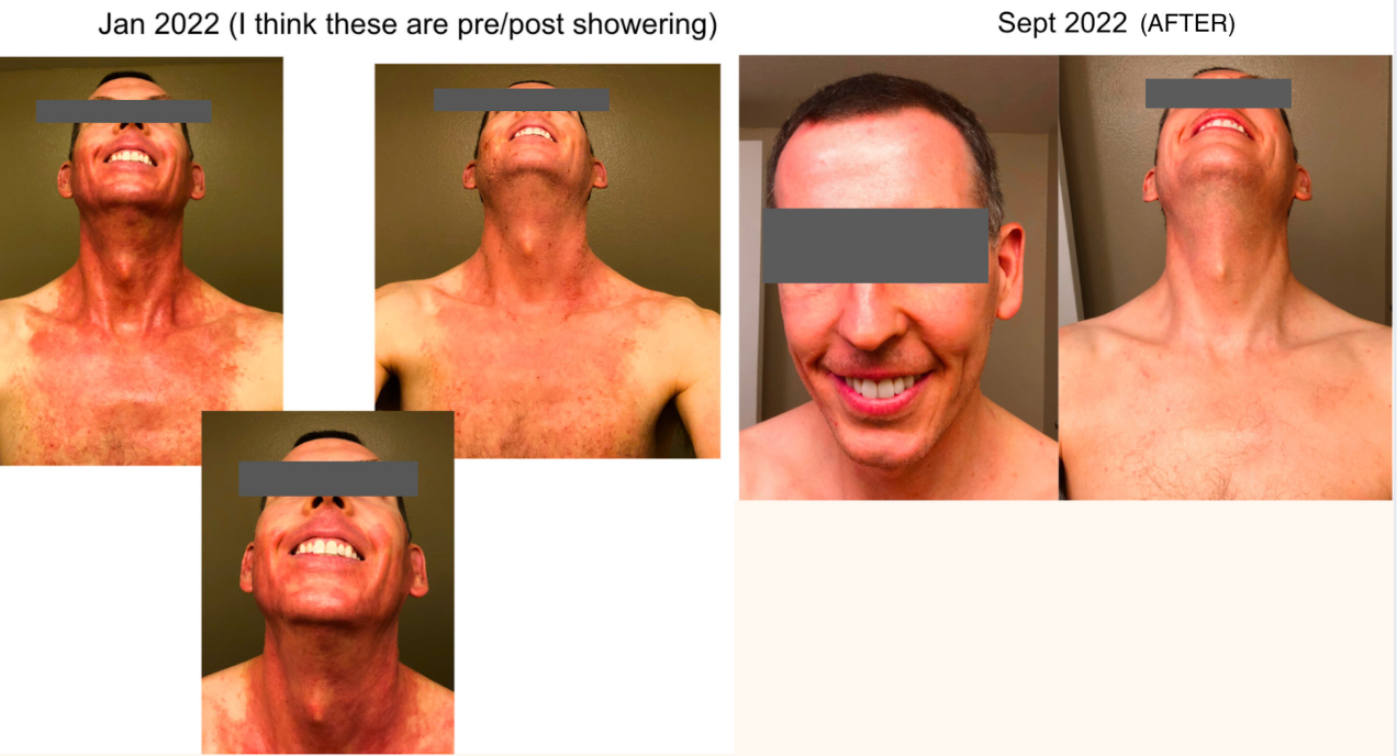 before and after eczema photos