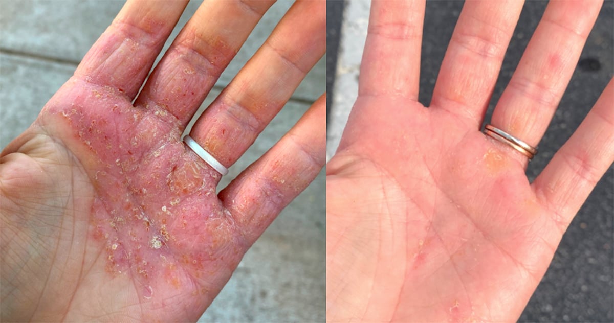 Client's hands with Eczema